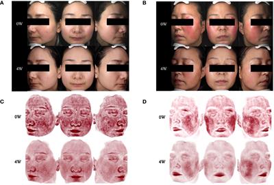 Treatment of rosacea with upadacitinib and abrocitinib: case report and review of evidence for Janus kinase inhibition in rosacea